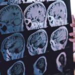 New guidance offers hope for reducing the global toll of dementia