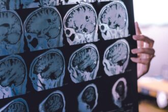 New guidance offers hope for reducing the global toll of dementia